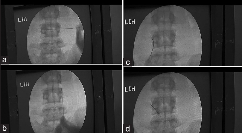 (a-d) marker along, bisection of pedicles at L45 and lateral pedicle line, next 2 images show the needle inserted over the transverse process over its upper border and then the mid portion of the transverse process